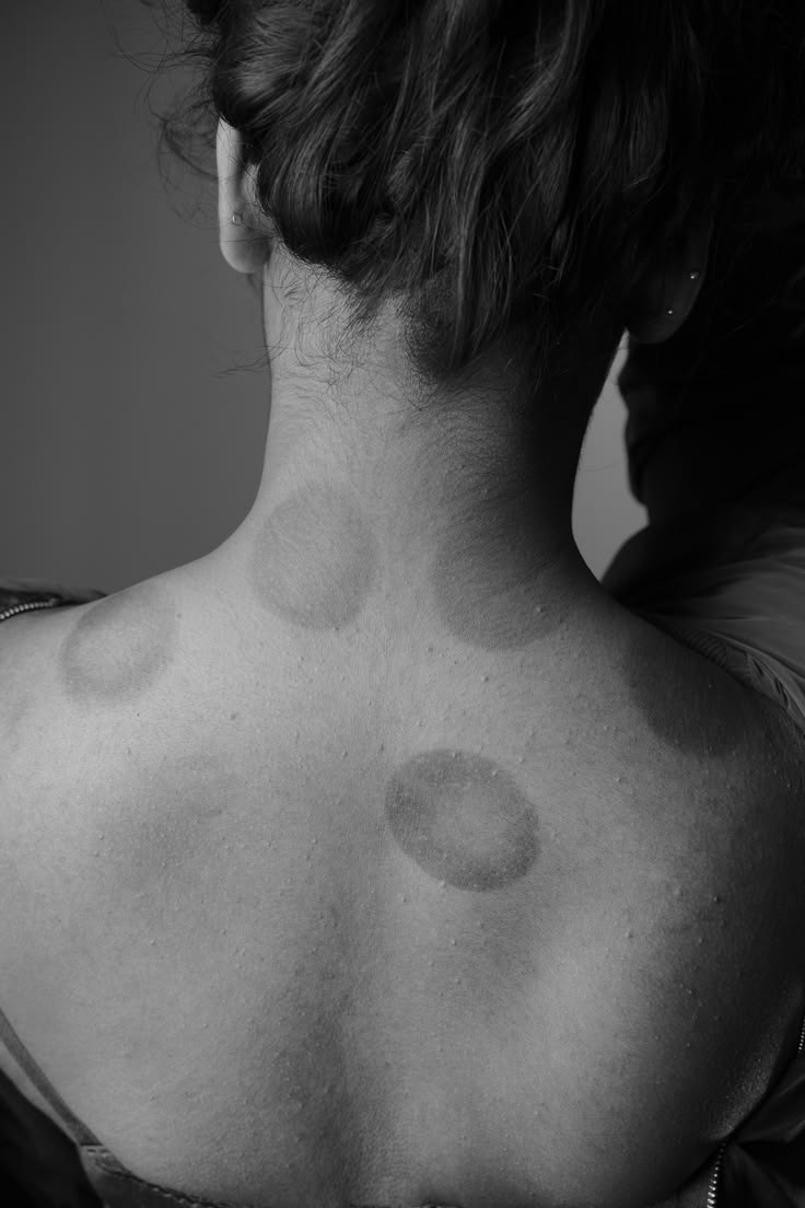 The upper back and neck of a woman with cupping marks